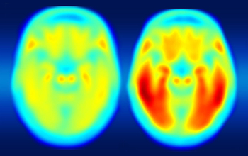 Scientists are investigating buildup and clearance of tau protein in brains of patients with Alzheimer’s disease
