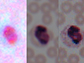blood smear from a cell phone camera (left), following enhancement by the algorithm (center), and taken by a lab microscope (right)